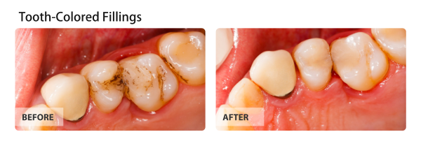 Tooth-Colored Fillings